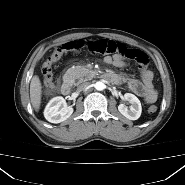 File:Acute pancreatitis (Radiopaedia 22572-22596 Axial C+ arterial phase 32).jpg