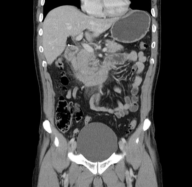 File:Acute pancreatitis (Radiopaedia 22572-22596 Coronal C+ portal venous phase 22).jpg