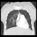 Acute pulmonary edema on CT (Radiopaedia 33582-34672 Coronal lung window 8).jpg