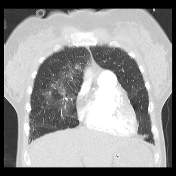 File:Acute pulmonary edema on CT (Radiopaedia 33582-34672 Coronal lung window 8).jpg