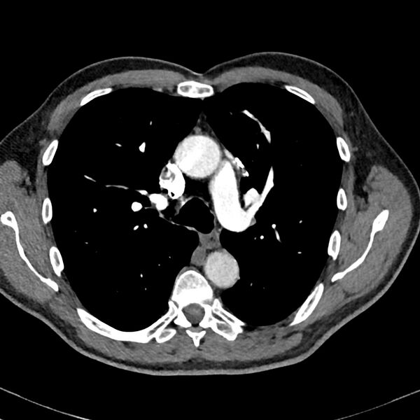 File:Acute pulmonary embolism (Radiopaedia 81677-95570 Axial C+ CTPA 32).jpg