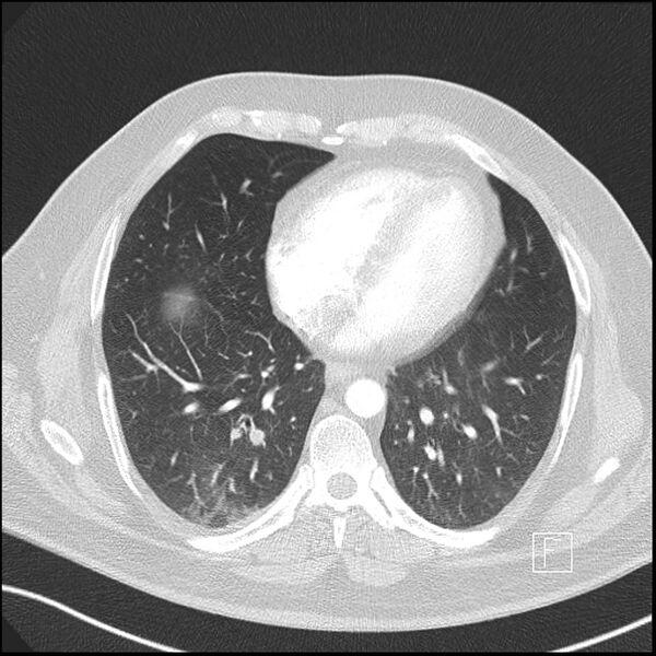 File:Acute pulmonary embolism with pulmonary infarct (Radiopaedia 73062-83768 Axial lung window 8).jpg