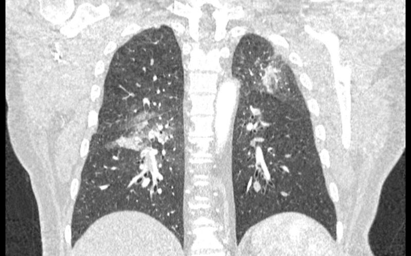 File:Acute pulmonary embolism with pulmonary infarcts (Radiopaedia 77688-89908 Coronal lung window 71).jpg