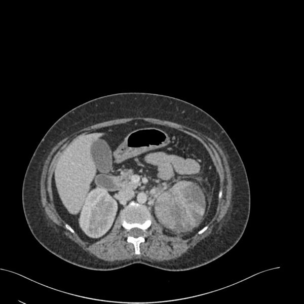 File:Acute pyelonephritis with renal vein thrombosis (Radiopaedia 58020-65053 Axial renal parenchymal phase 47).jpg