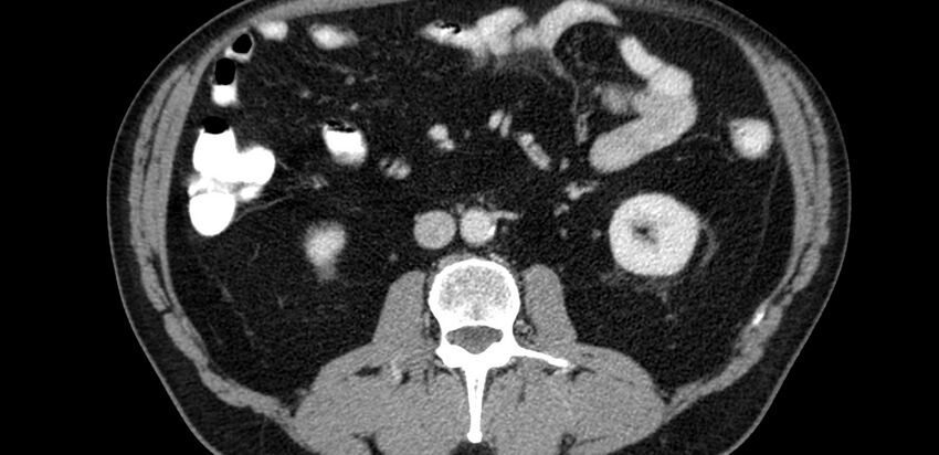 Acute sigmoid colon diverticulitis (Radiopaedia 55507-61976 Axial C+ portal venous phase 11).jpg