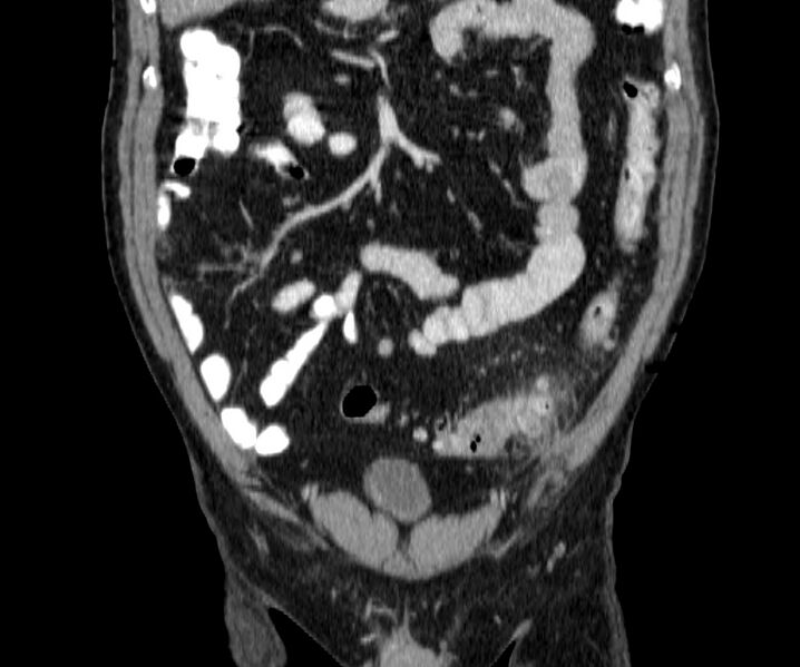 File:Acute sigmoid colon diverticulitis (Radiopaedia 55507-61976 Coronal C+ portal venous phase 37).jpg
