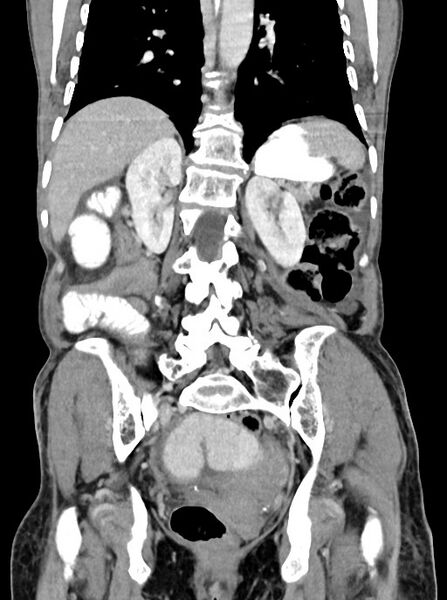 File:Acute small bowel (ileal) volvulus (Radiopaedia 71740-82139 Coronal C+ portal venous phase 79).jpg