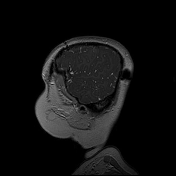 File:Adamantinomatous craniopharyngioma (Radiopaedia 77407-89529 H 108).jpg