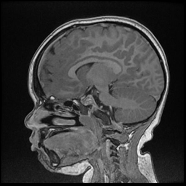 File:Adamantinomatous craniopharyngioma (Radiopaedia 77407-89529 Sagittal T1 C+ 59).jpg