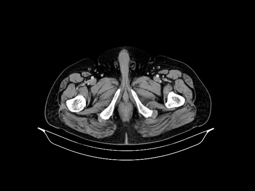 Adenocarcinoma of pancreas with hepatic metastasis (Radiopaedia 64332-73122 Axial C+ portal venous phase 106).jpg
