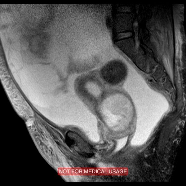 File:Adenocarcinoma of the cervix (Radiopaedia 28373-28615 Sagittal T2 fat sat 11).jpg