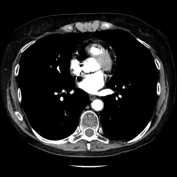 File:Adenocarcinoma of the lung (Radiopaedia 41015-43755 Axial C+ portal venous phase 72).jpg
