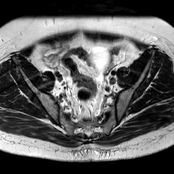 File:Adenomyoma of the uterus (Radiopaedia 9871-10439 Axial T2 22).jpg