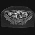 Adenomyosis and endometriotic cysts (Radiopaedia 82300-96367 Axial T1 C+ fat sat 28).jpg