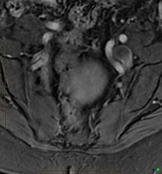 File:Adenomyosis uterus with hematometra (Radiopaedia 45779-50011 Axial T1 C+ fat sat 1).jpg