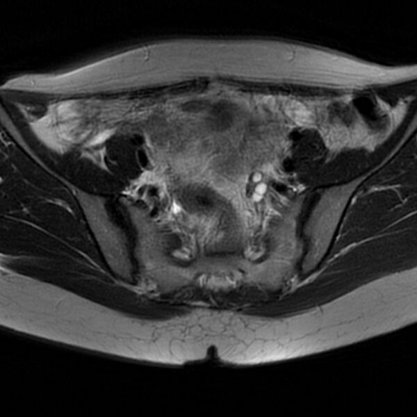 File:Adenomyosis within a septate uterus (Radiopaedia 69963-79981 Axial T2 14).jpg