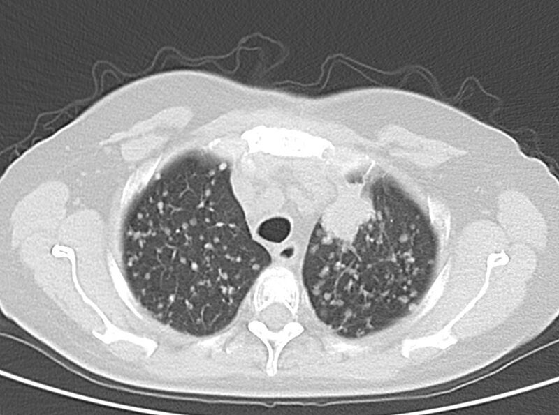 File:Adenosquamous lung carcinoma (Radiopaedia 22035-22030 lung window 19).jpg