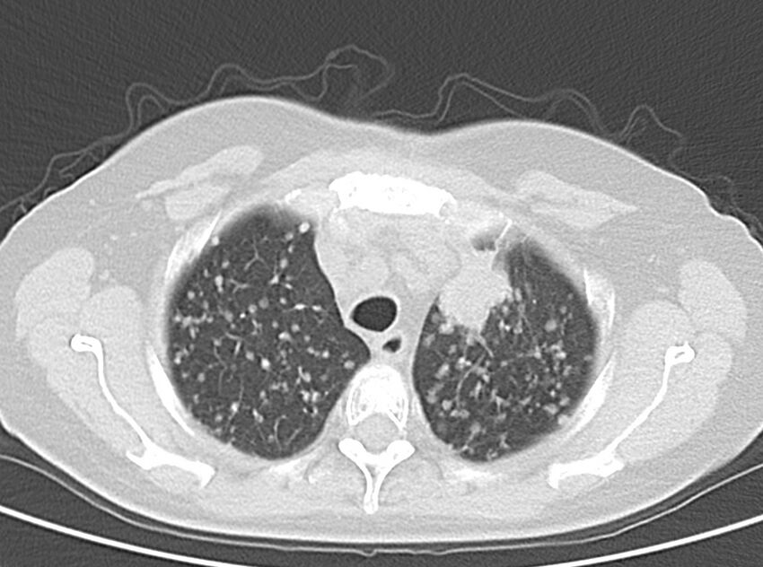 Adenosquamous lung carcinoma (Radiopaedia 22035-22030 lung window 19).jpg