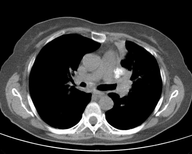 File:Adenosquamous lung carcinoma (Radiopaedia 22035-22030 non-contrast 29).jpg
