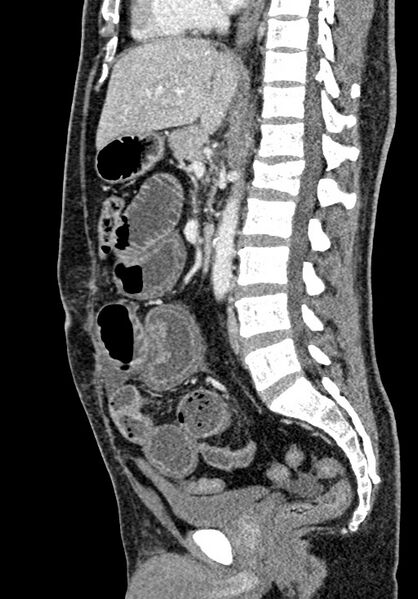 File:Adhesional small bowel obstruction (Radiopaedia 58900-66131 Sagittal C+ portal venous phase 128).jpg