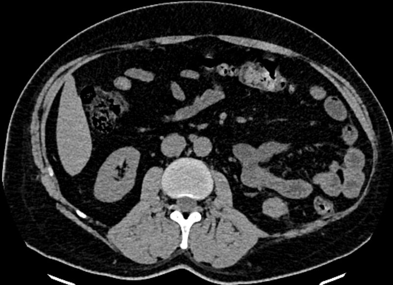 File:Adrenal metastases (Radiopaedia 73082-83791 Axial non-contrast 91).jpg