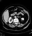 Adrenal myelolipoma (Radiopaedia 6765-7960 Axial C+ arterial phase 14).jpg