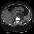 Adrenal myelolipoma (Radiopaedia 8216-9068 Axial non-contrast 14).jpg