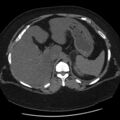 Adrenal myelolipoma (Radiopaedia 8216-9068 Axial non-contrast 5).jpg