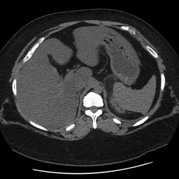 File:Adrenal myelolipoma (Radiopaedia 8216-9068 Axial non-contrast 5).jpg