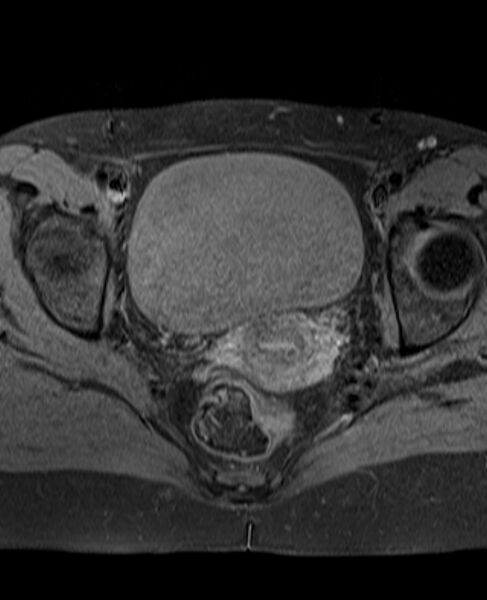 File:Adult granulosa cell tumor of the ovary (Radiopaedia 71581-81950 Axial T1 fat sat 18).jpg