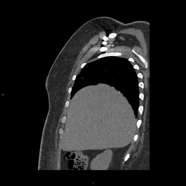 File:Agenesis of the left hepatic lobe (Radiopaedia 77284-89359 Sagittal C+ CTPA 20).jpg