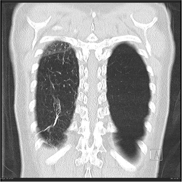 File:Alpha-1-antitrypsin deficiency (Radiopaedia 26537-26678 Coronal lung window 31).jpg