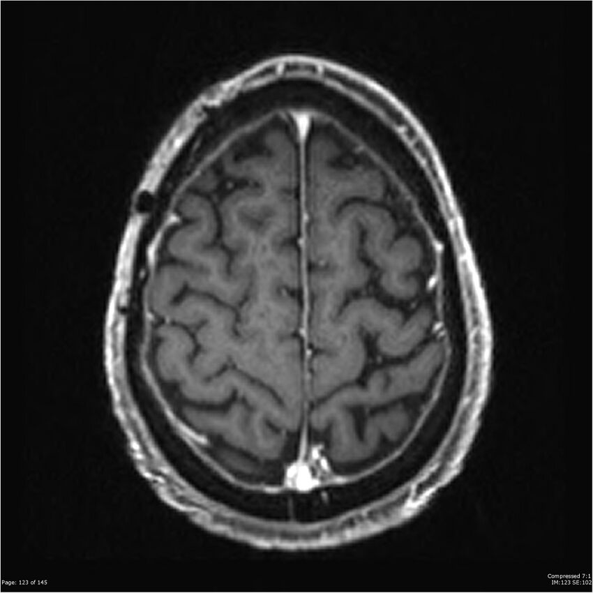 Anaplastic meningioma with recurrence (Radiopaedia 34452-35788 Axial T1 C+ 123).jpg