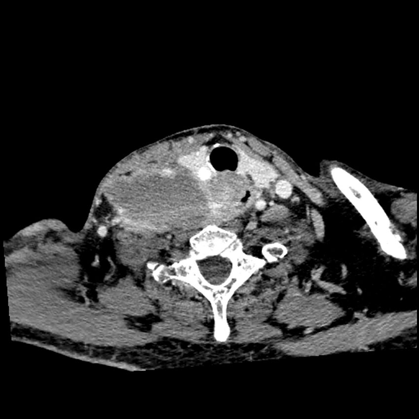 Anaplastic thyroid carcinoma (Radiopaedia 79087-92034 B 43).jpg