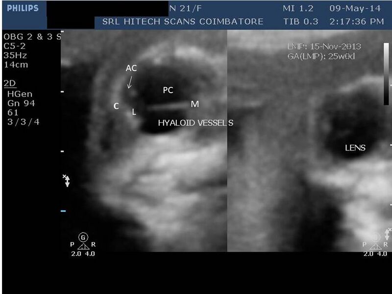File:Anatomy of fetal eye (Radiopaedia 29239).JPG