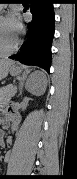 File:Aneurysmal bone cyst T11 (Radiopaedia 29294-29721 E 16).jpg