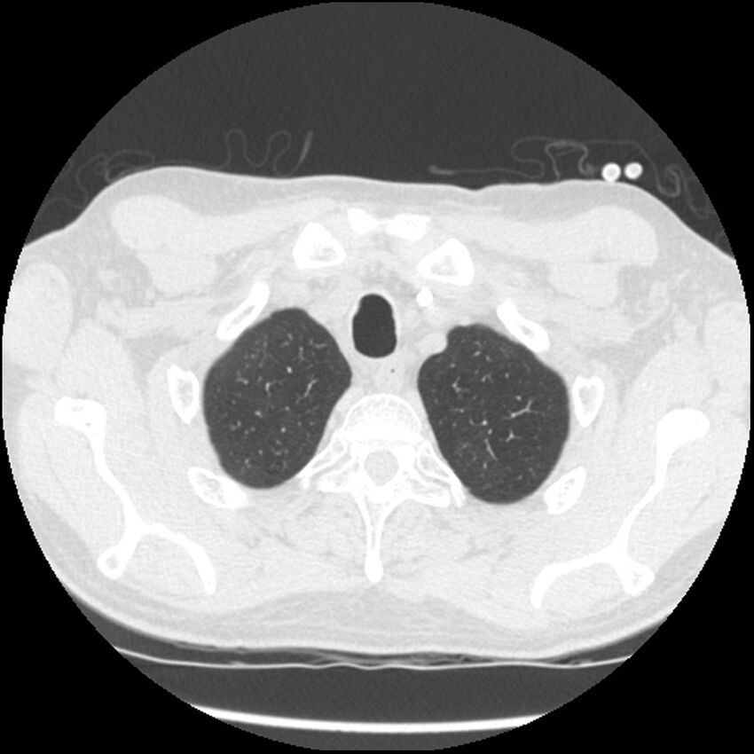 Angioinvasive aspergillosis (Radiopaedia 43957-47466 Axial lung window 11).jpg