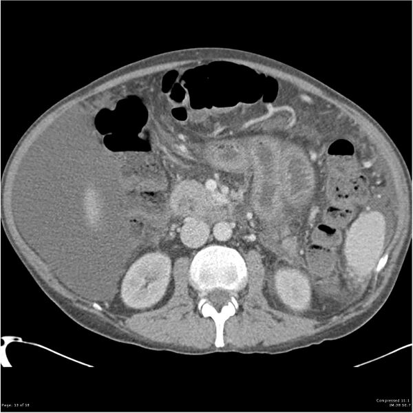File:Annular pancreas and cirrhosis (Radiopaedia 24561-24843 A 13).jpg