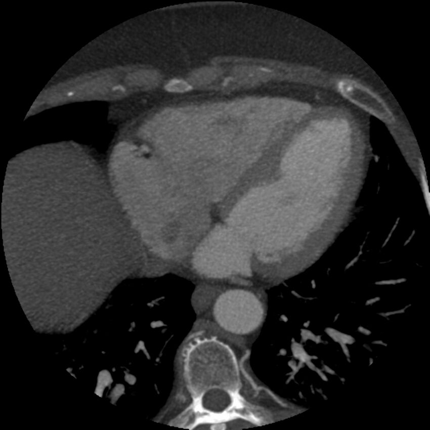 Anomalous origin of left circumflex artery from right coronary sinus (Radiopaedia 72563-83117 A 17).jpg