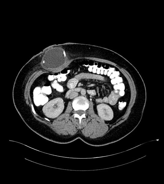 File:Anterior abdominal wall CSF pseudocyst (CSFoma) (Radiopaedia 79453-92571 A 44).jpg