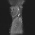 Anterior cruciate ligament full thickness tear (Radiopaedia 66268-75467 Coronal STIR 23).jpg