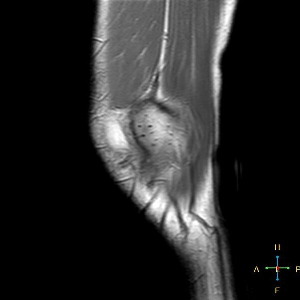 File:Anterior cruciate ligament tear - complete (Radiopaedia 24907-25170 Sagittal PD 18).jpg