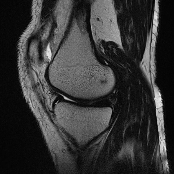 File:Anterior cruciate ligament tear - ramp lesion (Radiopaedia 71883-82322 Sagittal T2 17).jpg