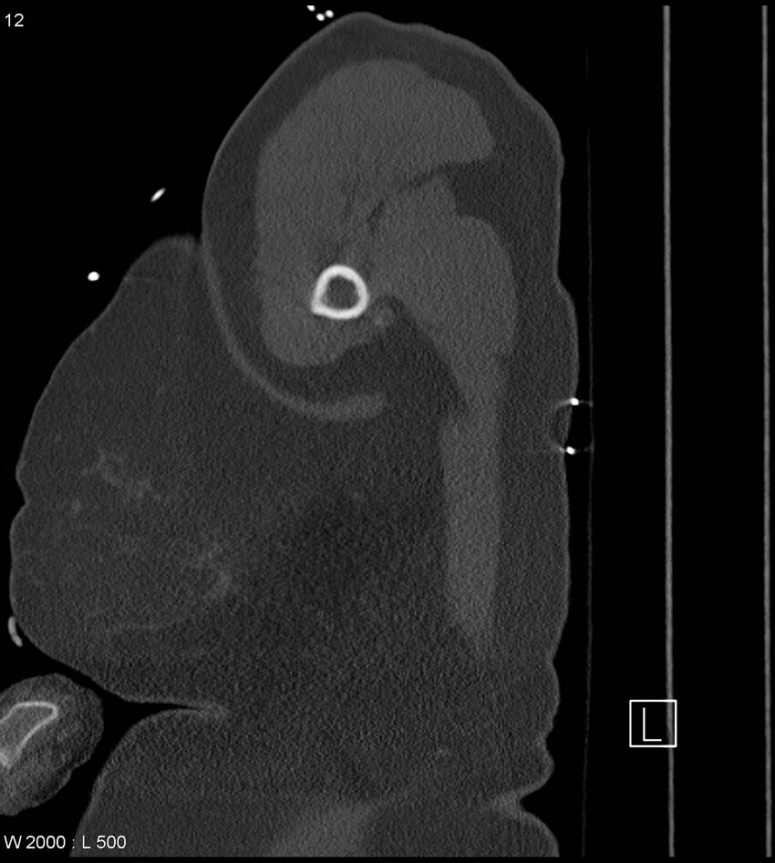 Anterior shoulder dislocation (CT) (Radiopaedia 59032-66309 Sagittal bone window 6).jpg