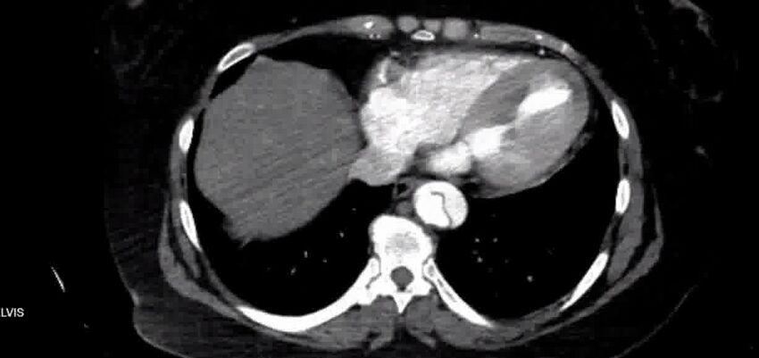 Aortic Dissection (Radiopaedia 85272-100847 A 34).jpg