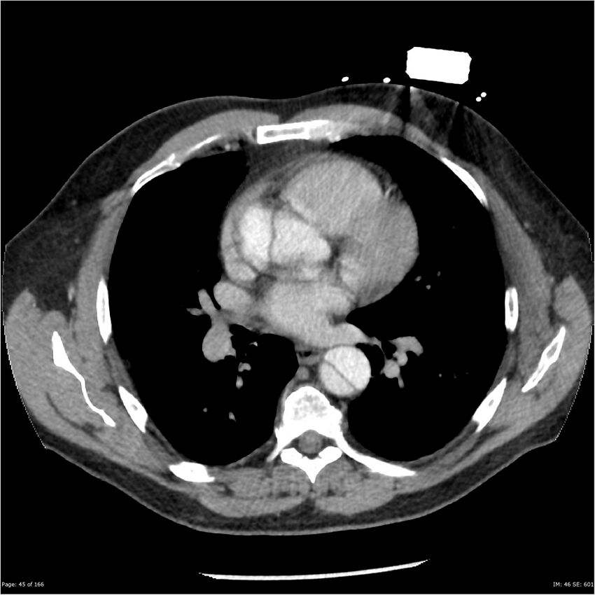 Aortic dissection- Stanford A (Radiopaedia 37759-39664 A 36).jpg