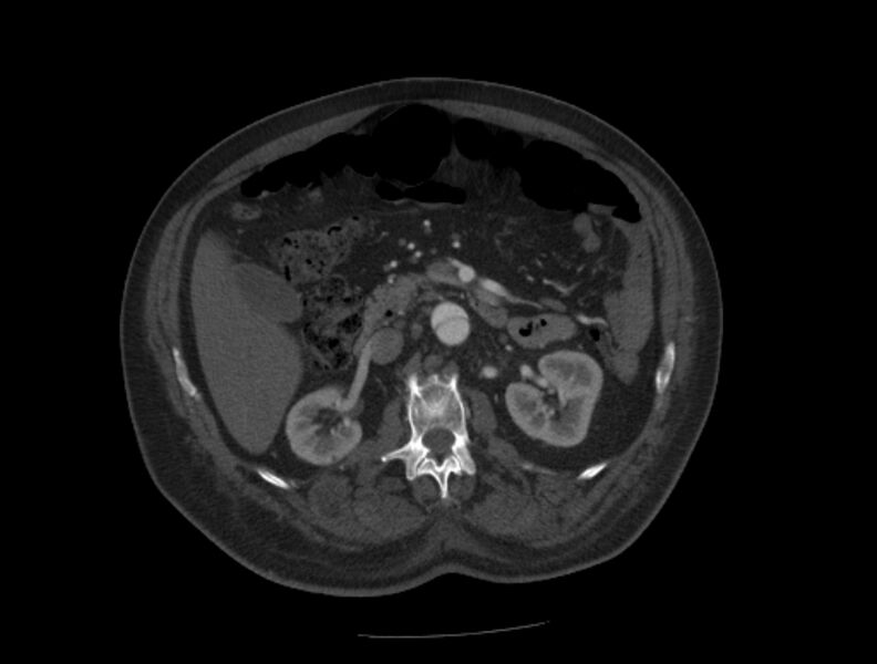 File:Aortic dissection (Radiopaedia 28802-29105 A 56).jpg
