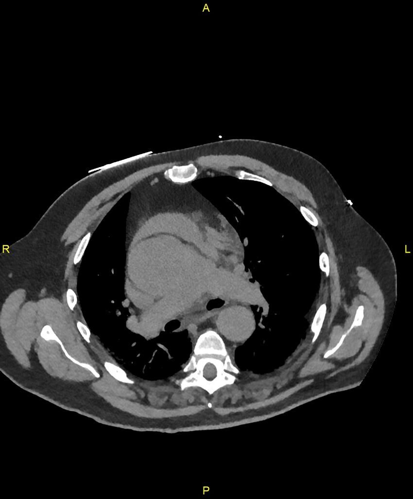 Aortic rupture (Radiopaedia 88822-105594 Axial non-contrast 90).jpg