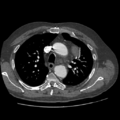 Aorto-coronary bypass graft aneurysms (Radiopaedia 40562-43157 A 36).png