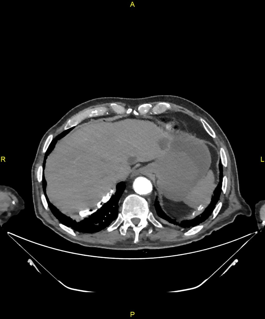 Aortoenteric fistula (Radiopaedia 84308-99603 B 32).jpg